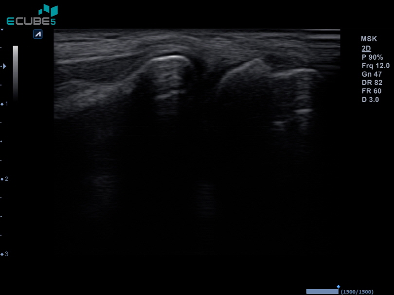 Lateral side of elbow