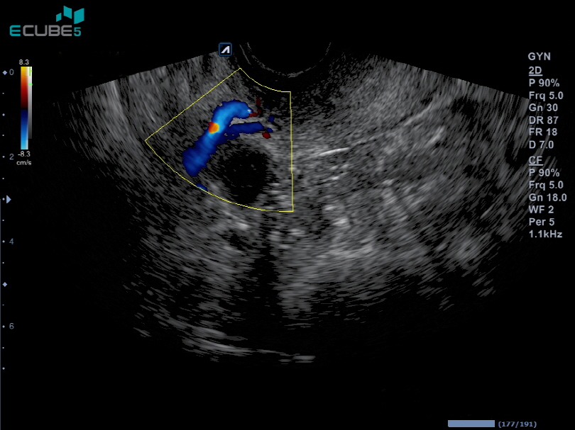 Color flow in endovaginal view