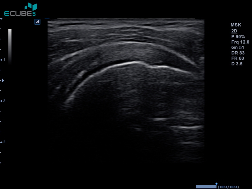 Shoulder supraspinatus