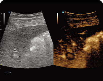 Contrast Enhancement Ultrasound (CEUS)