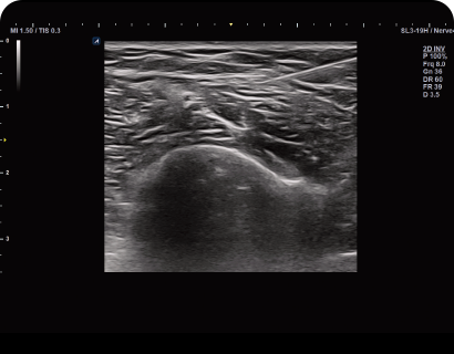 Needle Vision™ Plus