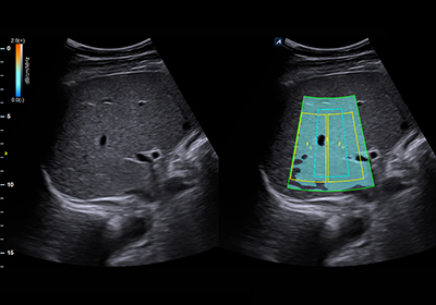 ATI(Attenuation Tissue Imaging)
